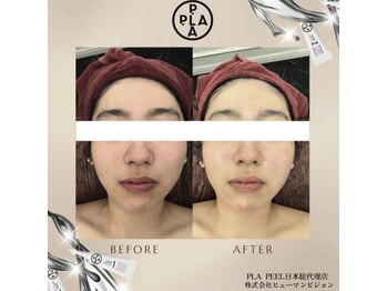 アドラーブル プレ葉ウォーク浜北店/プラピール　女性症例写真 3