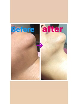 南国 蒼 越谷(ao)/細胞ケアビフォーアフター