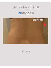 なごみ 菊池店/脂肪撃退【レモンボトル4cc】