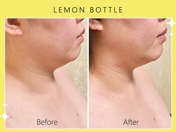 シロカネ 光の森店(SHIROKANE)/小顔コルギ×レモンボトル☆