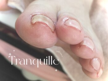トランキル(Tranquille)の写真/＃巻き爪矯正始めました♪【1本¥4000/左右2本¥8000】自爪が弱い方や小さい方等,ハードジェルで強い自爪に！