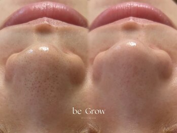 ビーグロウ(be Grow)/beforeafter