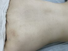 ナノハナ/鹿沼市全身脱毛美容室ナノハナ