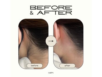 カルム(calm.)/【シュガーリング脱毛】¥2000