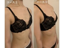 ギフト 浦和(GIFT)/バストアップ症例