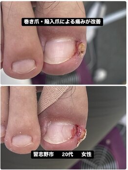 巻き爪じゅん 千葉駅前店/巻き爪・陥入爪による痛みが改善