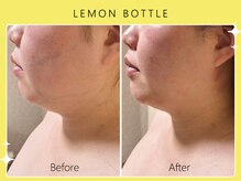 シロカネ 光の森店(SHIROKANE)/小顔コルギ×レモンボトル☆