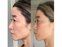 フラワー(FLOWER)/Lit私の肌変化