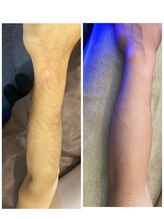 リレア(RELAIR)/【うで脱毛/ビフォーアフター】