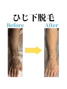 ヒゲマスター 小田原店/ひじ下脱毛
