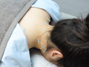 鍼灸院 整骨院ティップ 春日院/肩こりや首こりに対する鍼施術
