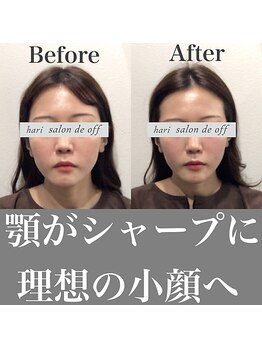 ハリサロンドオフ 心斎橋店(hari salon de off)/理想の小顔へ☆