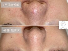 ラヴィオーラ 神戸三宮店(La Viora)/ダイヤモンドハーブピーリング