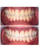 コナホワイトニング 神保町/ホワイトニング神保町