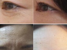 ナチュレアンドメディカ(Nature&Medica)/小じわ集中ケア(Wフェイシャル)