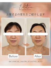 エクラヴィ(Eclatvie)/３０代★施術事例