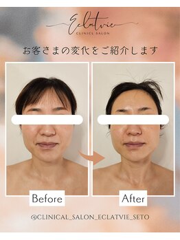 エクラヴィ(Eclatvie)/30代★施術事例