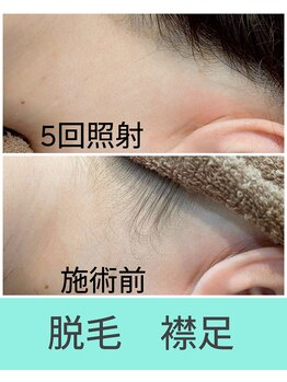 エミナル(EMINAL)/襟足脱毛の効果!脱毛/襟足/