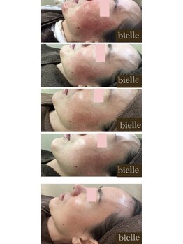 ビエル(Bielle)/世界でビエルだけ!肌改善術
