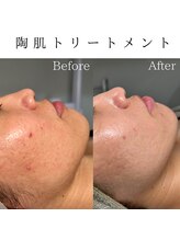 ビューティービューティー(BEAUTY BEAUTY)/陶肌トリートメントニキビケア