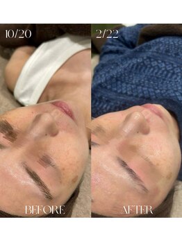 #美容革命ラボ 福岡春吉店/ハーブピーリング【天神春吉】