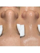 アイスリー(i III)/Before After