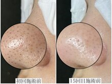 シエール 調布(Ci'aile)/本気の毛穴肌質改善