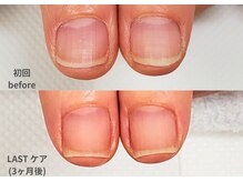 ナユネイル(na_yu.nail)/【地爪育成 症例１】