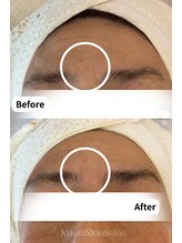 マウム(Maum)/眉間の深いシワにもアプローチ◎