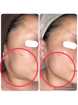 プリマ 大津店(PRIMA)/半永久的脂肪分解４回目経過中☆