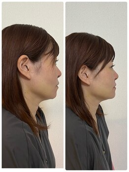 プラスチャーム(+charm)の写真/脂肪燃焼やダイエット効果を目指す方へ。毎分900ml水素が発生の最強コースで輝こう◎