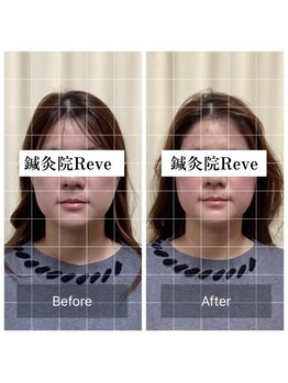 わきさか鍼灸整骨院・鍼灸院 レーヴ(Reve)/小顔矯正と美容鍼は相性抜群☆