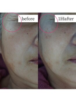 アップルミント/＜フェイシャル＞before・after