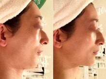 ホワイトカメリア(White Camellia)/【小顔矯正】持続するリフト