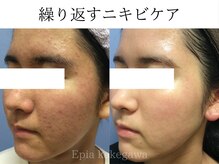 フェイシャル専門店 エピア 掛川店(Epia)の雰囲気（繰り返す肌荒れ・ニキビケアはお任せください！）