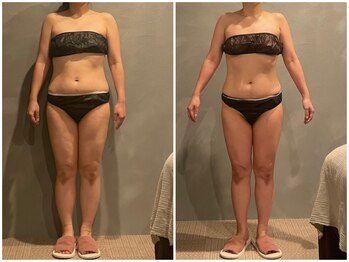 ツーアップ(2up)/全身むくみ、たるみ