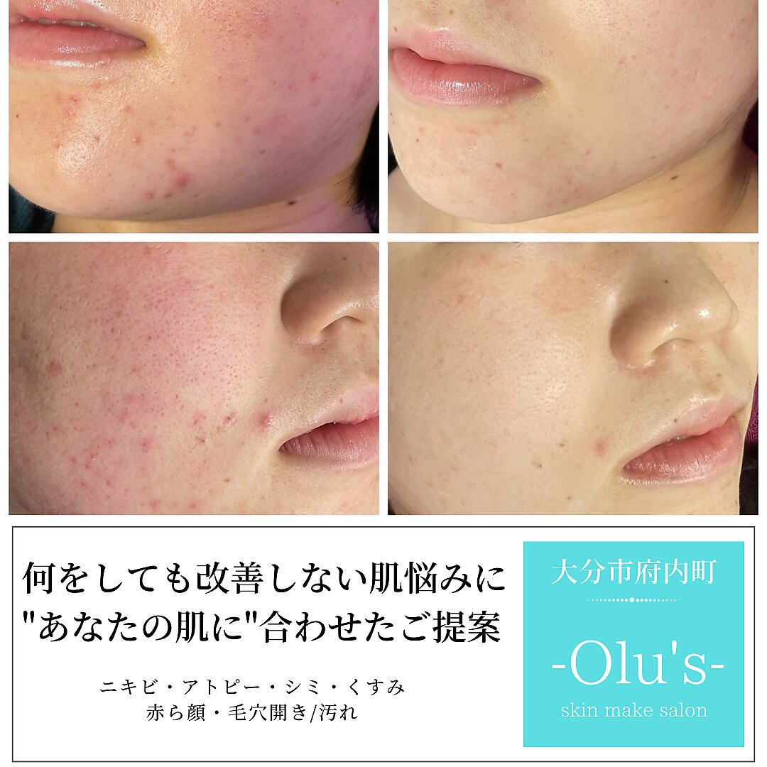 毛穴エステ 込900円 整形級 毛穴エステは専門店へ！【毛穴エクストラクションプロ（R）で