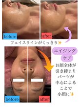 ユフラ(Juhla)/切らない小顔リフトサーマル