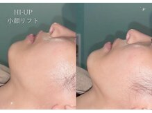 ベル 大和(Belle)/HI-UP｜小顔リフト