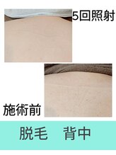 エミナル(EMINAL)/背中脱毛の効果！脱毛/毛穴/