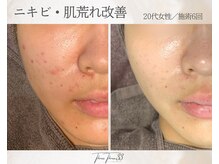 スリースリー 恵比寿(THREE THREE)/ニキビ・肌荒れケア