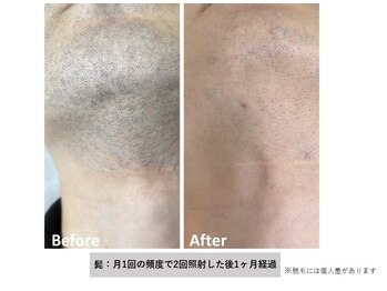 レア(Rea)/メンズひげ脱毛