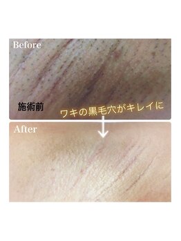 ラウレア 西条店(LAULEA)/脇脱毛before/after