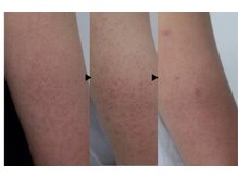 デジール/ザラザラ二の腕ケア