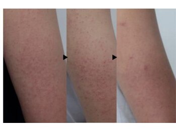 デジール/ザラザラ二の腕ケア