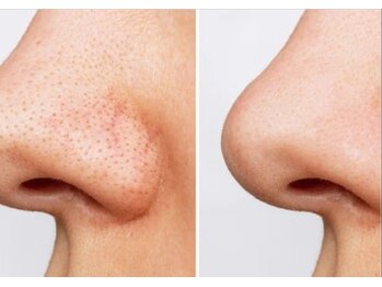 アイ アンド ネイルデイ 桂(EYE&NAIL DAY)/毛穴汚れ、毛穴の黒ずみ解消