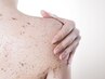 肌見せの季節到来 -繰り返す背中ニキビケアから解放-
