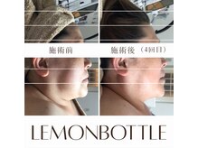 ベイジョ デ アンジョ(Beijo de anjo)/レモンボトル