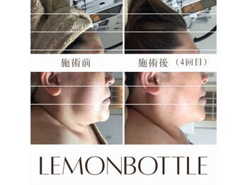 ベイジョ デ アンジョ(Beijo de anjo)/レモンボトル