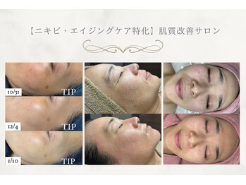 ベル(Belle)の写真/【完全結果重視】人気のハーブピーリングによるワンランク上の本気の肌質改善で「隠す日々から魅せる肌へ」